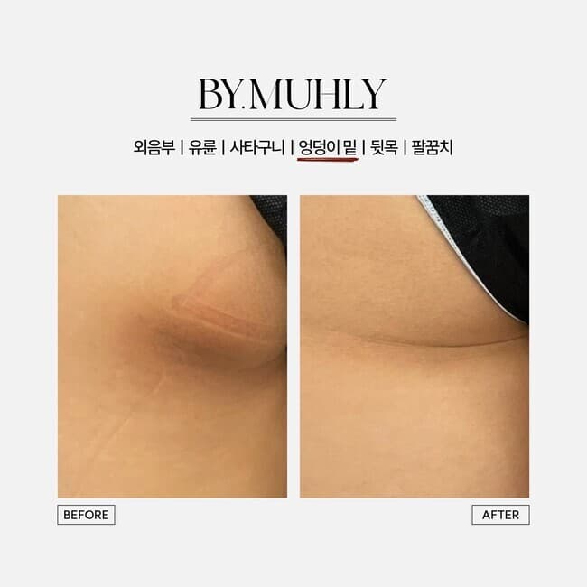 엉덩이 밑 멜라닌 케어