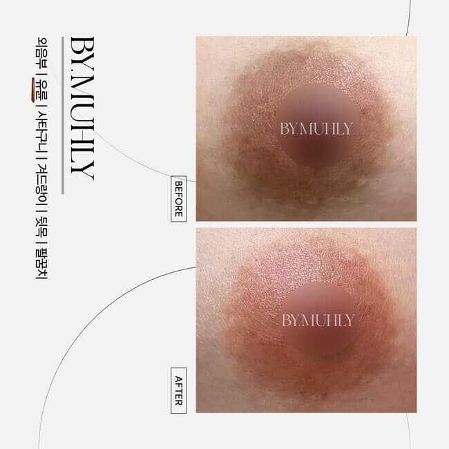 유륜 멜라닌 케어